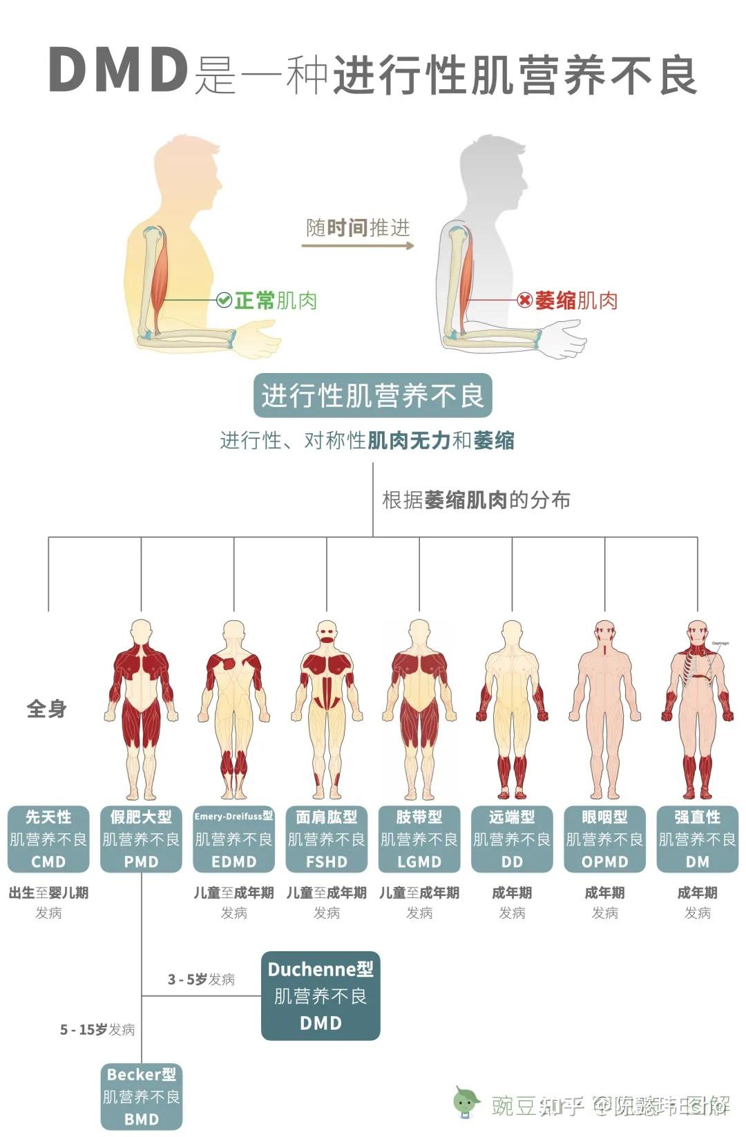 肌營(yíng)養(yǎng)不良研究最新進(jìn)展，自信與成就感的源泉